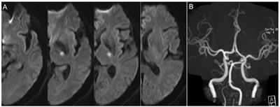 A lesion extending three or more slices as a predictor of progressive infarction in anterior circulation small subcortical infarction